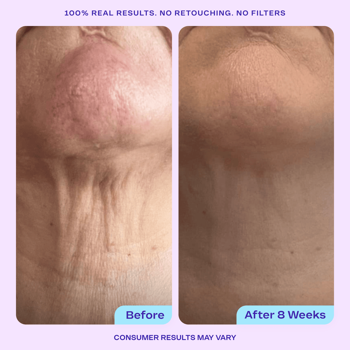 Side-by-side “Before” and “After 8 Weeks” close-up photos showing improvement in the appearance of neck skin. Text above reads “100% Real Results. No Retouching. No Filters.” with “Consumer results may vary” below.