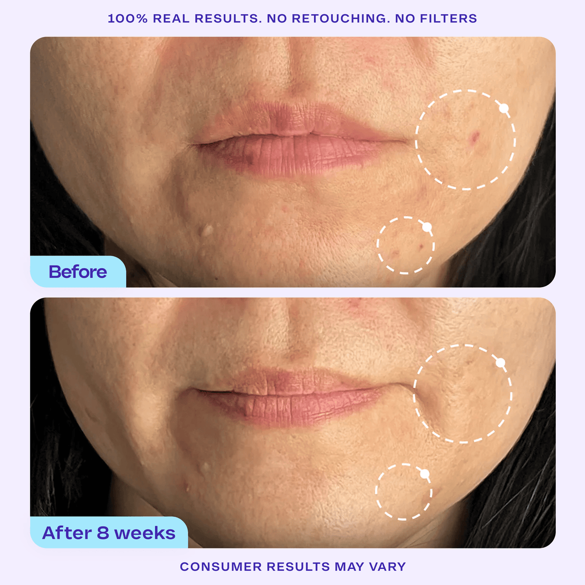 “Before” and “After 8 Weeks” comparison photos of the lower face. “Before” image shows visible blemishes and uneven texture, while the “After” image reveals smoother skin with fewer visible imperfections. Text reads: “100% real results. No retouching. No filters.” and "Consumer results may vary"